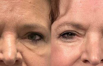 patient had bilateral upper and lower blepharoplasty, frontal view before (left) and 3 months after surgery (right)