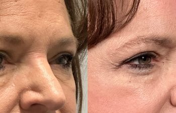 patient had bilateral upper and lower blepharoplasty, shown right oblique before (left) and 3 months after surgery (right)