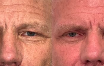 patient had bilateral upper blepharoplasty and a direct brow lift, shown in frontal view before (left) and 2 months after surgery (right)