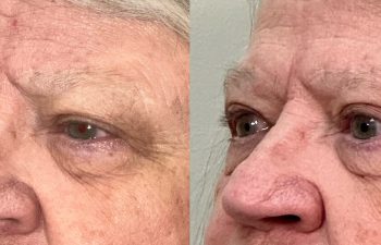 patient had brow repair, upper blepharoplasty, and correction of ptosis and entropion, shown in left oblique view before (left) and 3 months after surgery (right)