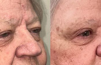 patient had brow repair, upper blepharoplasty, and correction of ptosis and entropion, shown in right oblique view before (left) and 3 months after surgery (right)