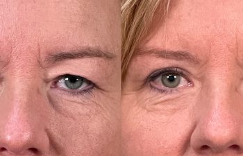 patient had bilateral upper blepharoplasty, shown in frontal view before (left) and after surgery (right)