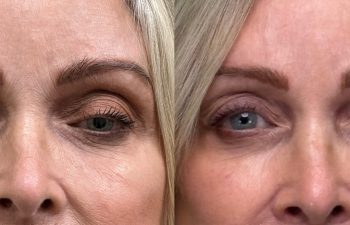 patient had bilateral upper blepharoplasty and ptosis repair, shown in frontal view before (left) and 10 months after surgery (right)