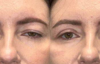 patient had bilateral upper blepharoplasty and ptosis repair, shown in frontal view before (left) and 6 weeks after surgery (right)