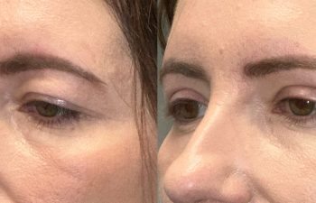 patient had bilateral upper blepharoplasty and ptosis repair, shown in left oblique view before (left) and 6 weeks after surgery (right)
