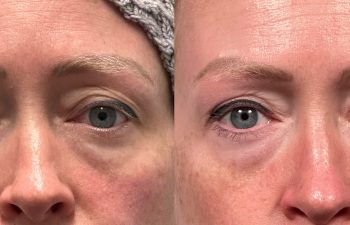 patient had bilateral upper eyelid blepharoplasty with medial fat reduction, shown in frontal view before (left) and after surgery (right)