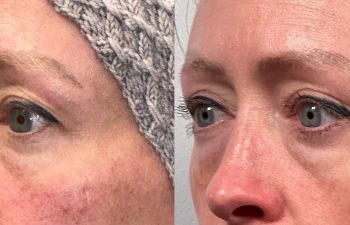 patient had bilateral upper eyelid blepharoplasty with medial fat reduction, shown in left oblique view before (left) and after surgery (right)